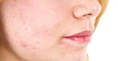 causes of facial rashes Wolt disney nude